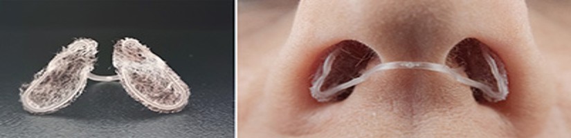 Der Nasenfilter, um die individuelle Belastung mit Allergenen zu erfassen. Im 2. Bild sieht man den Nasenfilter in einer Nase.